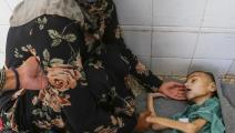 سوء التغذية الحاد يفتك بأطفال غزة (أشرف أبو عمرة/ الأناضول)