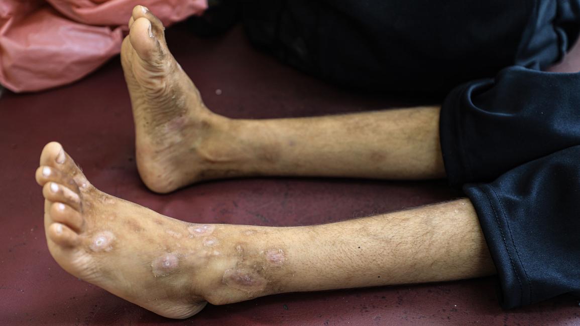أمراض جلدية تفتك بأطفال نازحين في غزة