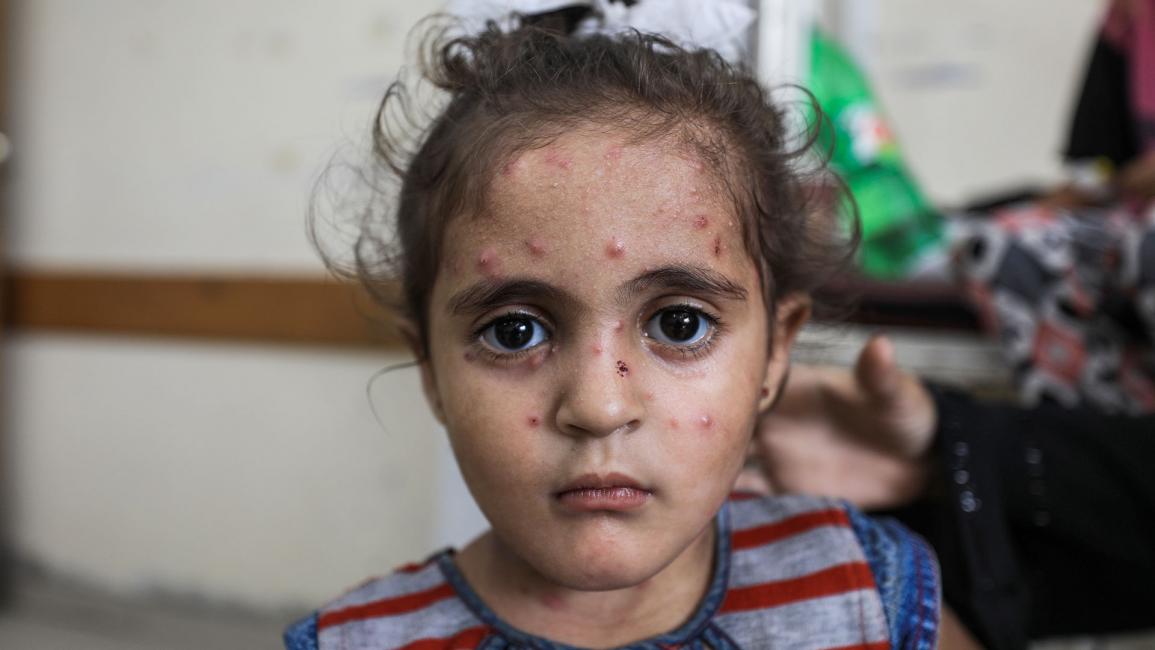 أمراض جلدية تفتك بأطفال نازحين في غزة