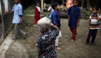 طفل مصاب بالمهق في إندونيسيا (أديتيا إروان/ Getty)