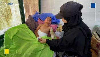 معاناة طفل حرقته نيران الاحتلال في مخيم النصيرات
