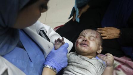 طفل فلسطيني مصاب في حرب إسرائيل على غزة - مستشفى شهداء الأقصى في دير البلح وسط قطاع غزة - 13 يونيو 2024 (أشرف أبو عمرو/ الأناضول)